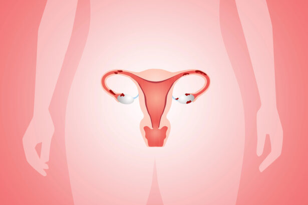 sintomas da endometriose